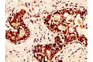 IHC image of nphHU diluted at 1:50 and staining in paraffin-embedded human breast cancer performed on a Leica BondTM system. (H2AFX Antikörper)