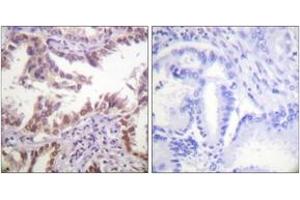 Immunohistochemistry analysis of paraffin-embedded human lung carcinoma tissue, using Histone H3 (Ab-14) Antibody. (Histone 3 Antikörper  (AA 6-55))