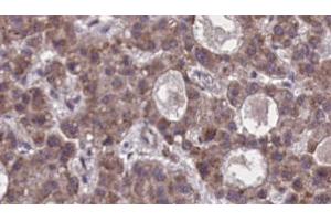 ABIN6273876 at 1/100 staining Human liver cancer tissue by IHC-P. (FFAR2 Antikörper  (C-Term))