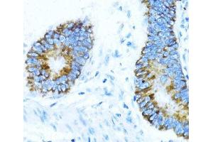 Immunohistochemistry of paraffin-embedded Human colon carcinoma using NOX1 Polyclonal Antibody at dilution of 1:100 (40x lens). (NOX1 Antikörper)