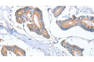 Immunohistochemistry of paraffin-embedded Human colon cancer tissue using MTMR7 Polyclonal Antibody at dilution 1:40 (MTMR7 Antikörper)