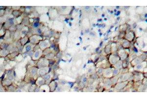 Immunohistochemistry of paraffin-embedded Human breast carcinoma using Phospho-IGF1R(Y1161) Polyclonal Antibody (IGF1R Antikörper  (pTyr1161))