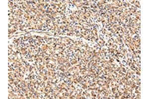The image on the left is immunohistochemistry of paraffin-embedded Human prostate cancer tissue using ABIN7189649(ADAMTS1 Antibody) at dilution 1/35, on the right is treated with synthetic peptide. (ADAMTS1 Antikörper)
