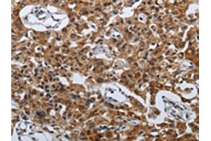 The image on the left is immunohistochemistry of paraffin-embedded Human lung cancer tissue using ABIN7192614(SPAG4 Antibody) at dilution 1/50, on the right is treated with synthetic peptide. (SPAG4 Antikörper)