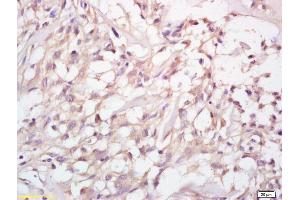 Formalin-fixed and paraffin embedded human cervical carcinoma labeled with Anti-MMP-23 Polyclonal Antibody, Unconjugated (ABIN759176) at 1:200 followed by conjugation to the secondary antibody (Matrix Metallopeptidase 23 (MMP23) (AA 281-380) Antikörper)