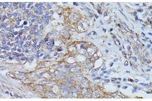 Immunohistochemistry of paraffin-embedded Human lung cancer using CTTN Polyclonal Antibody at dilution of 1:100 (40x lens). (Cortactin Antikörper)