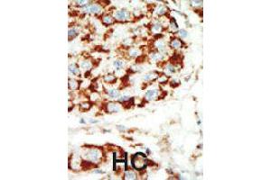 Formalin-fixed and paraffin-embedded human hepatocellular carcinoma tissue reacted with PRKAB1 polyclonal antibody  , which was peroxidase-conjugated to the secondary antibody, followed by AEC staining . (PRKAB1 Antikörper  (N-Term))