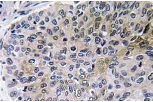 Immunohistochemistry analysis of NGF Antibody in paraffin-embedded human lung carcinoma tissue. (Nerve Growth Factor Antikörper)