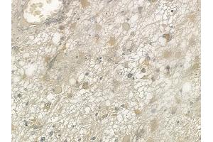 ABIN6257381 and ABIN6273726 at 1/100 staining human astrocytoma by IHC-P.