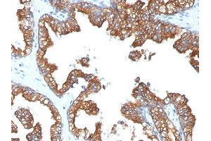 Formalin-fixed, paraffin-embedded human Prostate Carcinoma stained with Cytokeratin 8/18 Monoclonal Antibody (5D3). (CK8 & CK18 Antikörper)