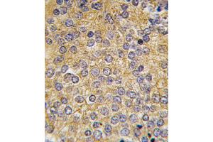 Formalin-fixed and paraffin-embedded human prostata carcinoma tissue reacted with PLAU antibody (N-term), which was peroxidase-conjugated to the secondary antibody, followed by DAB staining. (PLAU Antikörper  (N-Term))