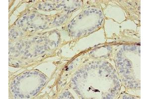 Immunohistochemistry of paraffin-embedded human breast cancer using ABIN7168555 at dilution of 1:100 (SKP2 Antikörper  (AA 1-424))