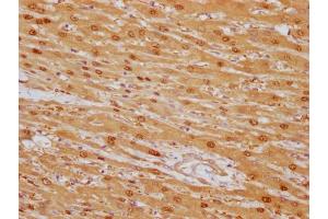IHC image of ABIN7180448 diluted at 1:100 and staining in paraffin-embedded human liver cancer performed on a Leica BondTM system. (Liver Arginase Antikörper)