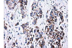 Immunohistochemical staining of paraffin-embedded Carcinoma of liver tissue using anti-ATP5Bmouse monoclonal antibody. (ATP5B Antikörper)