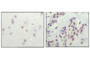 Immunohistochemical analysis of paraffin-embedded human cerebra (left) and breast carcinoma tissue (right), showing nuclear location with DAB staining using NCOR1 mouse mAb.