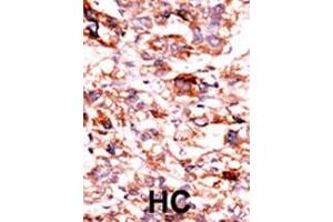 Formalin-fixed and paraffin-embedded human cancer tissue reacted with the primary antibody, which was peroxidase-conjugated to the secondary antibody, followed by AEC staining. (ADCK5 Antikörper  (C-Term))