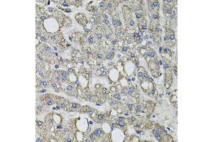 Immunohistochemistry of paraffin-embedded human liver injury using GFPT1 antibody at dilution of 1:100 (x40 lens).