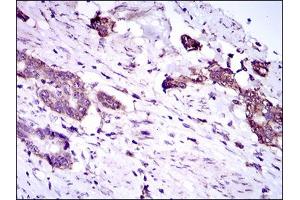 Immunohistochemical analysis of paraffin-embedded esophageal cancer tissues using DNAL4 mouse mAb with DAB staining. (DNAL4 Antikörper  (AA 1-105))