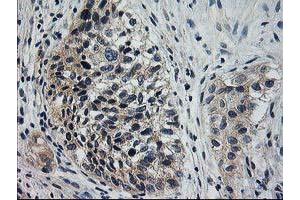 Immunohistochemical staining of paraffin-embedded Carcinoma of Human bladder tissue using anti-XPNPEP3 mouse monoclonal antibody. (XPNPEP3 Antikörper)