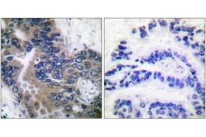 Immunohistochemistry analysis of paraffin-embedded human lung carcinoma tissue, using APAF-1-ALT Antibody. (APAF1 Antikörper  (AA 289-338))
