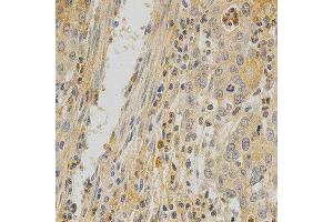 Immunohistochemistry of paraffin-embedded human stomach cancer using TNFRSF11B antibody at dilution of 1:200 (x400 lens) (Osteoprotegerin Antikörper  (AA 22-280))