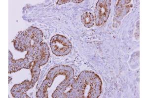 IHC-P Image ACADM antibody detects ACADM protein at mitochondria on human colon carcinoma by immunohistochemical analysis. (Medium-Chain Specific Acyl-CoA Dehydrogenase, Mitochondrial (MCAD) (Center) Antikörper)