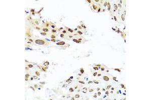 Immunohistochemistry of paraffin-embedded human lung cancer using RAB3IP antibody at dilution of 1:100 (x40 lens). (RAB3IP Antikörper)