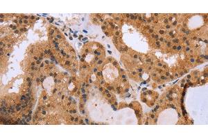 Immunohistochemistry of paraffin-embedded Human thyroid cancer using EPDR1 Polyclonal Antibody at dilution of 1:40