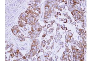 IHC-P Image Immunohistochemical analysis of paraffin-embedded OECM1 xenograft, using Fatty Acid Synthase, antibody at 1:500 dilution. (Fatty Acid Synthase Antikörper  (N-Term))