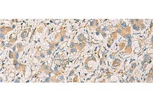 Immunohistochemistry of paraffin-embedded Human liver cancer tissue using GNAZ Polyclonal Antibody at dilution of 1:70(x200) (GNaZ Antikörper)