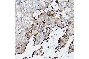 Immunohistochemistry of paraffin-embedded human lung cancer using Mucin 5AC (MUC5AC) antibody (ABIN7268694) at dilution of 1:50 (40x lens). (MUC5AC Antikörper  (C-Term))