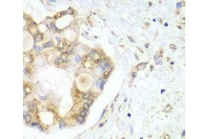 Immunohistochemistry of paraffin-embedded Human liver cancer using VTI1B Polyclonal Antibody at dilution of 1:100 (40x lens). (VTI1B Antikörper)