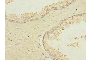 Immunohistochemistry of paraffin-embedded human prostate cancer using ABIN7172867 at dilution of 1:100 (TRPM4 Antikörper  (AA 1-240))