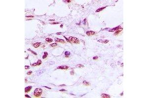 Immunohistochemical analysis of DNA Ligase 4 staining in human prostate cancer formalin fixed paraffin embedded tissue section. (LIG4 Antikörper)
