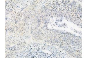 ABIN6261112 and ABIN6277999 at 1/100 staining human cervical carcinoma by IHC-P.