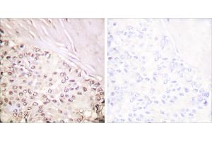 Peptide - +Immunohistochemical analysis of paraffin-embedded human breast carcinoma tissue using FANCD2 (Ab-222) antibody (#B0427). (FANCD2 Antikörper  (Ser222))