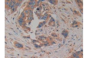 Detection of PK2 in Human Breast cancer Tissue using Polyclonal Antibody to Prokineticin 2 (PK2) (PROK2 Antikörper  (AA 30-128))