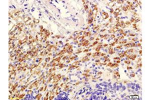Formalin-fixed and paraffin embedded mouse tumor with labeled Anti-phospho-AKT/PKB(Ser473) Polyclonal Antibody, Unconjugated (ABIN729298) at 1:600, followed by conjugation to the secondary antibody and DAB staining (AKT 1/2/3 Antikörper  (pSer473))