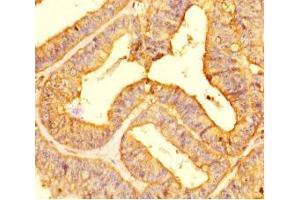 Immunohistochemistry of paraffin-embedded human endometrial cancer using ABIN7158346 at dilution of 1:100