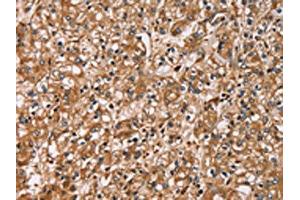 The image on the left is immunohistochemistry of paraffin-embedded Human prostate cancer tissue using ABIN7129785(HTR3C Antibody) at dilution 1/30, on the right is treated with fusion protein. (HTR3C Antikörper)
