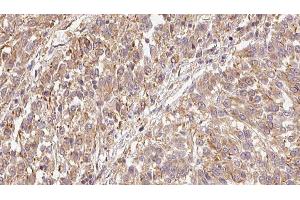 ABIN6279444 at 1/100 staining Human Melanoma tissue by IHC-P. (FGF9 Antikörper  (N-Term))