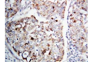 Anti-MEK1 antibody, IHC(P) IHC(P): Human Lung Cancer Tissue (MEK1 Antikörper  (C-Term))