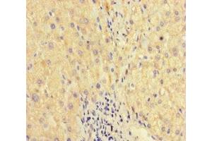 Immunohistochemistry of paraffin-embedded human liver cancer using ABIN7175867 at dilution of 1:100 (WAC Antikörper  (AA 10-102))