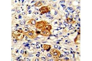 IHC analysis of FFPE human breast carcinoma with C5 antibody (C5 Antikörper  (AA 253-281))