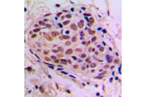 Immunohistochemical analysis of CREB staining in human breast cancer formalin fixed paraffin embedded tissue section. (CREB1 Antikörper  (Center))