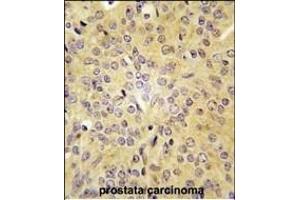 Formalin-fixed and paraffin-embedded human prostata carcinoma tissue reacted with LARS antibody (C-term) (ABIN391611 and ABIN2841532) , which was peroxidase-conjugated to the secondary antibody, followed by DAB staining.