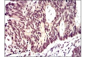 Immunohistochemical analysis of paraffin-embedded rectum cancer tissues using ID2 mouse mAb with DAB staining. (Id2 Antikörper  (AA 1-134))