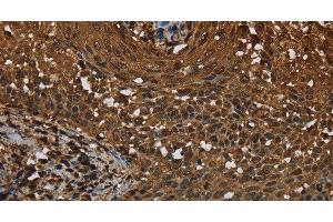 Immunohistochemistry of paraffin-embedded Human cervical cancer tissue using MYBBP1A Polyclonal Antibody at dilution 1:40 (MYBBP1A Antikörper)