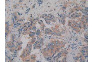 IHC-P analysis of Human Breast Cancer Tissue, with DAB staining. (AZGP1 Antikörper)