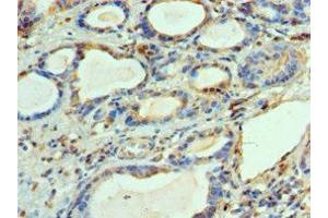 Immunohistochemistry of paraffin-embedded human prostate cancer using ABIN7144450 at dilution of 1:100 (BCL2L14 Antikörper  (AA 1-327))